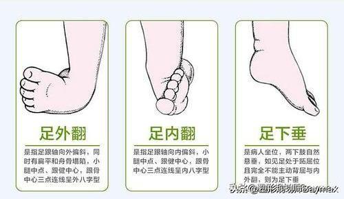 辟谣：走路外八字可以矫正O型腿？别闹了，正确的矫正需要这3步